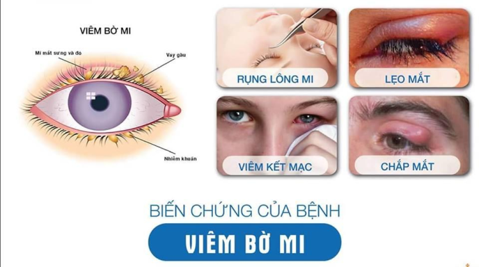 nhung-dieu-can-biet-ve-viem-bo-mi-mat
